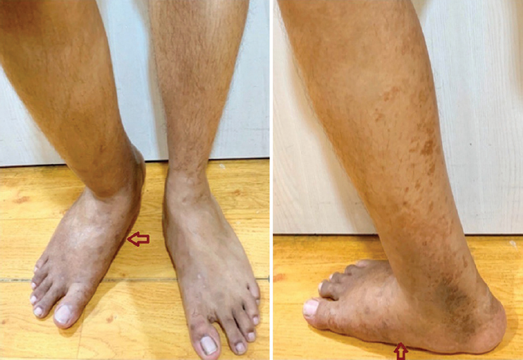 Clinical photograph of the (A) foot, ankle, and (B) leg, showing deformity on the right side, with discolouration of the skin (arrows).